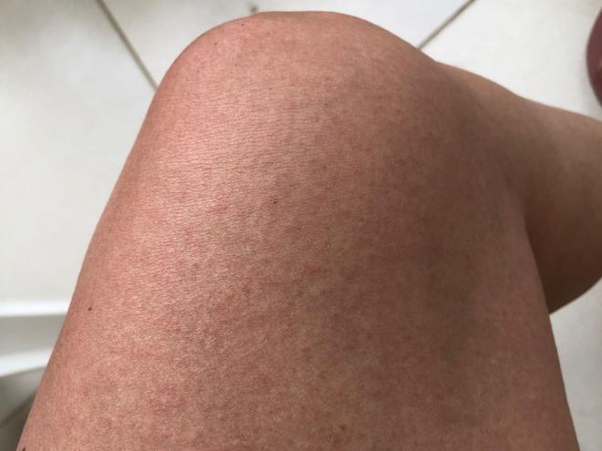 A moradora do bairro Esperança apresentou vermelhidão na pele, sintoma muito comum da dengue: ''todo o corpo ficou assim'', contou 