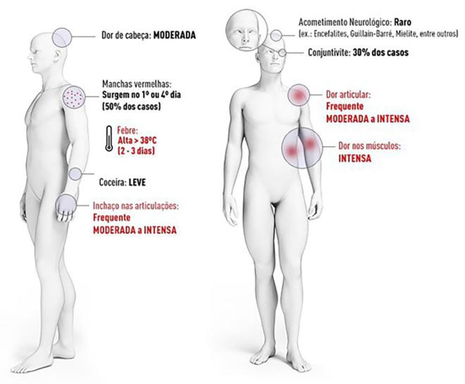 Além das dores intensas nas articulações, são sintomas da chikungunya: febre, dor nas costas, pelo corpo, erupção avermelhada na pele