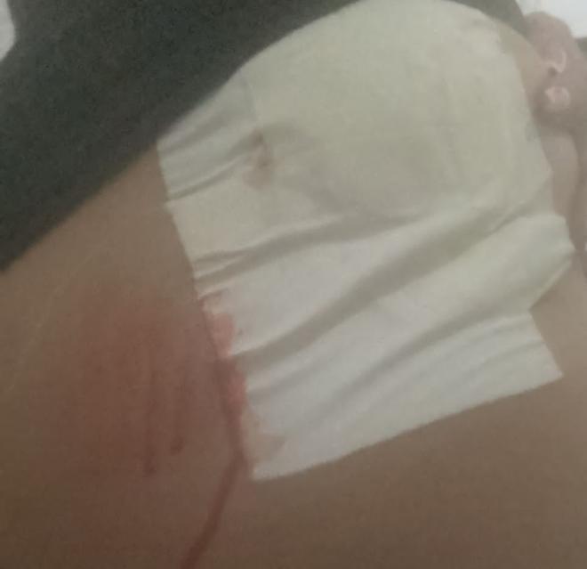 Neste domingo, a jovem divulgou em suas mídias sociais a foto do curativo do local onde a bala entrou 
