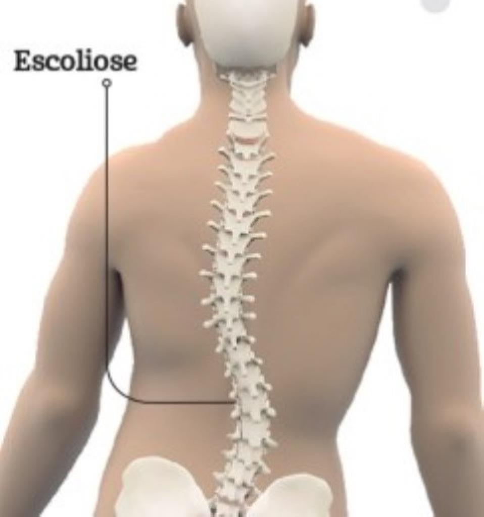 Não deixe que te digam que você não pode! - Projeto Escoliose