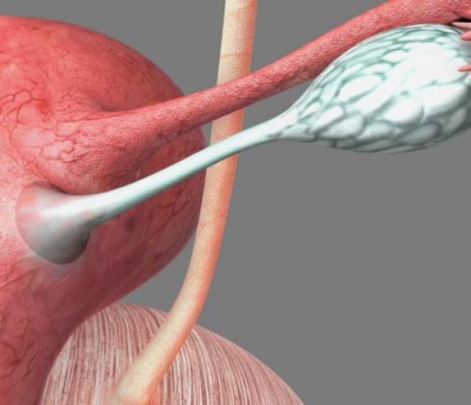 Estima-se que em 85% dos casos, a DIP é causada por micro-organismos sexualmente transmissíveis