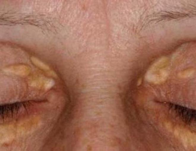 Em alguns casos, pode-se remover o xantelasma no mesmo tempo da cirurgia de blefaroplastia