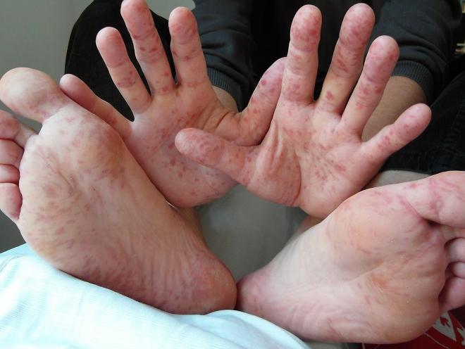 Feridas avermelhadas na planta dos pés, mãos e interior da garganta podem ser indicações de contaminação pelo vírus da síndrome mão-pé-boca