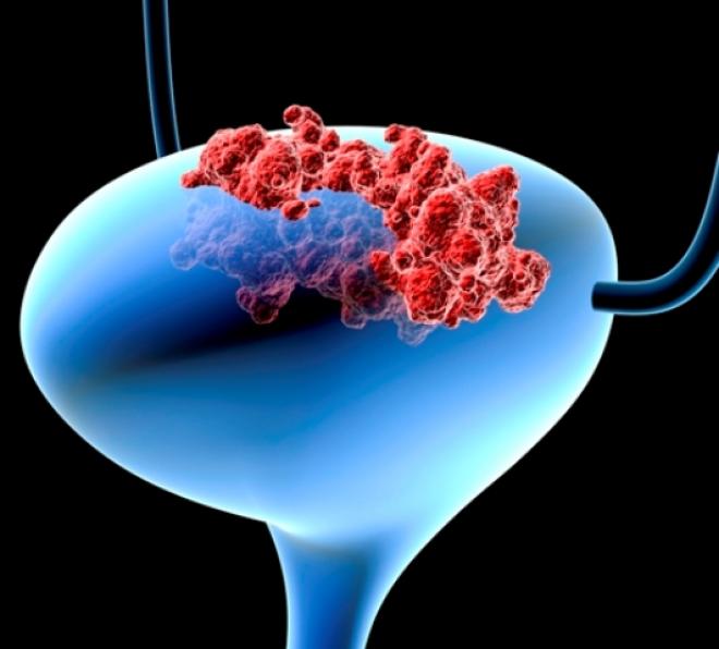 O carcinoma de células transicionais é o tipo de tumor mais comum, com mais de 90% dos casos segundo o INCA