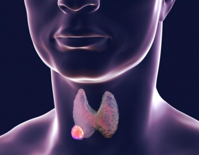 Dores na parte anterior do pescoço e nódulos endurecidos, que persistem por mais de 20 dias podem ser sinais do tumor