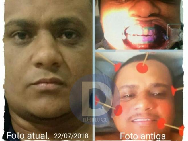 Vaguinho realizou cirurgia plástica para mudar o rosto