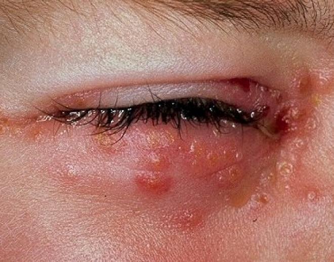 Algumas situações podem desencadear uma crise de herpes