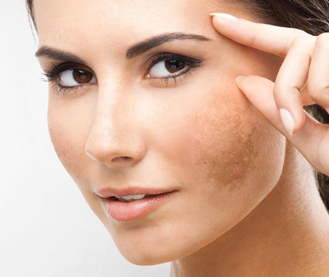 O melasma é uma hiperpigmentação da pele