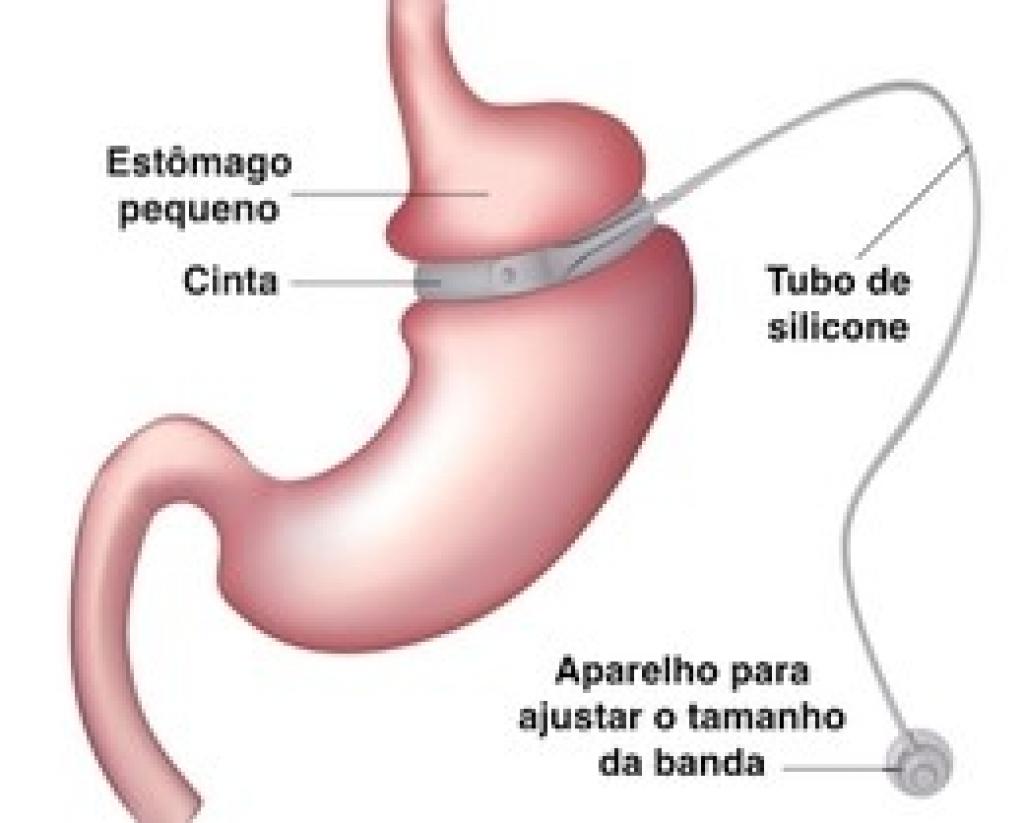 Cirurgia bariátrica sensibiliza o organismo ao consumo de álcool