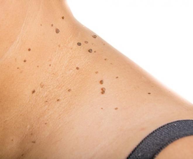 Geralmente, pintas, sardas ou sinais surgem por dois fatores: herança genética e excesso de sol