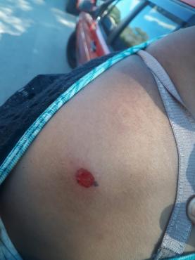 Mulher saiu ferida com tiro de borracha no ombro 