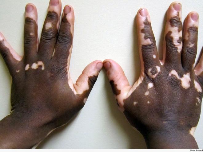 Dermatose que ocasionem comprometimento estético, a exemplo do vitiligo, não podem servir de critério eliminatório em concurso para a PMMG e o Corpo de Bombeiros