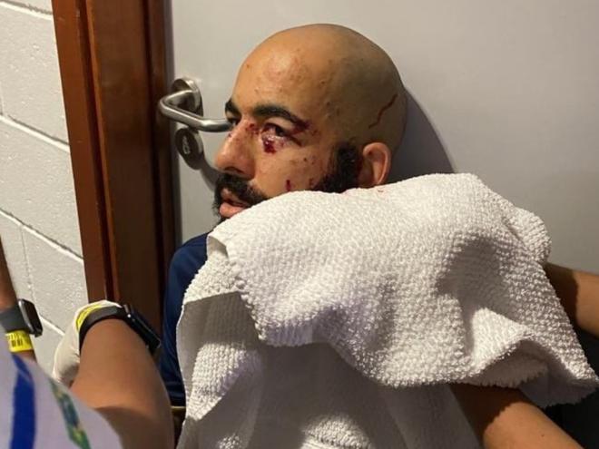 Danilo Fernandes teve ferimentos no rosto após uma bomba ser jogada no ônibus do clube antes da partida contra o Sampaio Corrêa, na Arena Fonte Nova, pela Copa do Nordeste