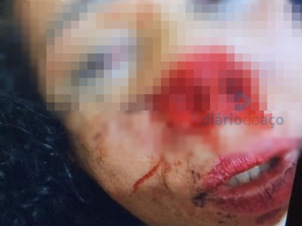 A vítima de 47 anos teve a parte do nariz arrancada com a mordida